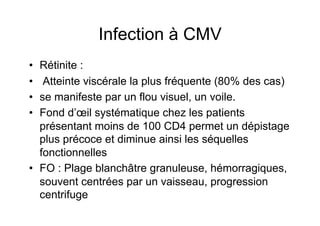Infection à CMV
•  Rétinite :
•   Atteinte viscérale la plus fréquente (80% des cas)
•  se manifeste par un flou visuel, un voile.
•  Fond d’œil systématique chez les patients
   présentant moins de 100 CD4 permet un dépistage
   plus précoce et diminue ainsi les séquelles
   fonctionnelles
•  FO : Plage blanchâtre granuleuse, hémorragiques,
   souvent centrées par un vaisseau, progression
   centrifuge
 