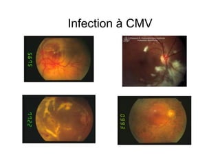 Infection à CMV
 