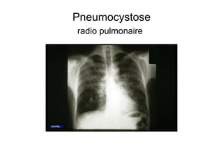 Pneumocystose
radio pulmonaire
 