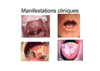 Manifestations cliniques
 