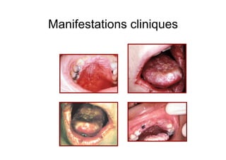 Manifestations cliniques
 