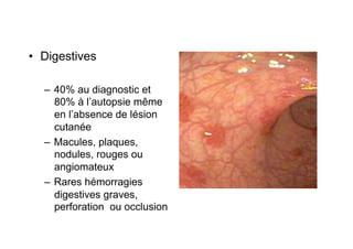 •  Digestives

  –  40% au diagnostic et
     80% à l’autopsie même
     en l’absence de lésion
     cutanée
  –  Macules, plaques,
     nodules, rouges ou
     angiomateux
  –  Rares hémorragies
     digestives graves,
     perforation ou occlusion
 