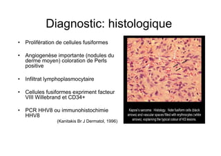 Diagnostic: histologique
•  Prolifération de cellules fusiformes

•  Angiogenèse importante (nodules du
   derme moyen) coloration de Perls
   positive

•  Infiltrat lymphoplasmocytaire

•  Cellules fusiformes expriment facteur
   VIII Willebrand et CD34+

•  PCR HHV8 ou immunohistochimie
   HHV8
                (Kanitakis Br J Dermatol, 1996)
 