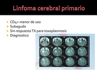  CD4+ menor de 100
 Subagudo
 Sin respuestaTX para toxoplasmosis
 Diagnostico
 
