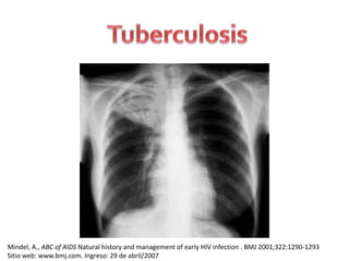 Mindel, A., ABC of AIDS Natural history and management of early HIV infection . BMJ 2001;322:1290-1293
Sitio web: www.bmj.com. Ingreso: 29 de abril/2007
 