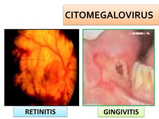 RETINITIS GINGIVITIS
 