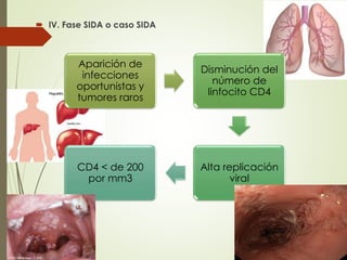  IV. Fase SIDA o caso SIDA
Aparición de
infecciones
oportunistas y
tumores raros
Disminución del
número de
linfocito CD4
Alta replicación
viral
CD4 < de 200
por mm3
 