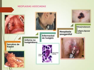 Sarcoma de
Kaposi
Linfoma no
hodgkidiano
Enfermedad
de hodgkin
Neoplasia
anogenital
Otras(melanom
a
maligno,liposar
coma
NEOPLASIAS ASOCIADAS
 