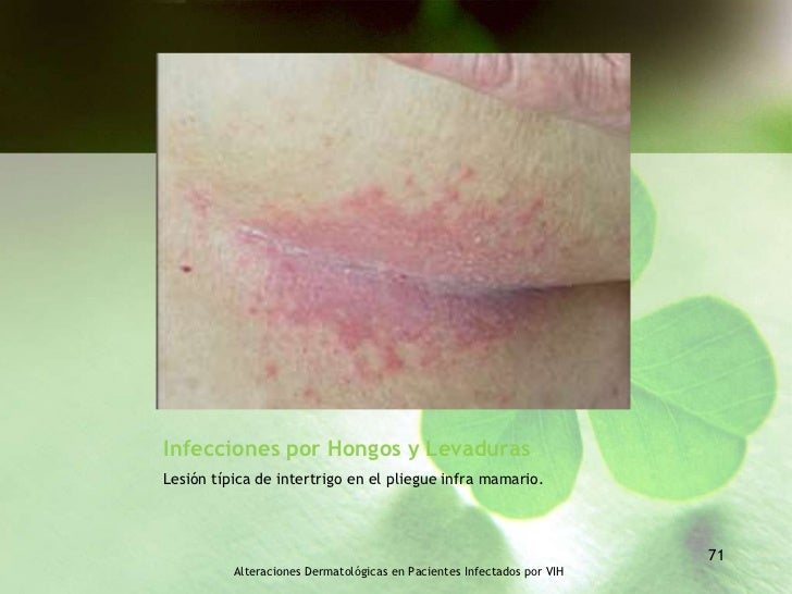 Vih y dermatosis