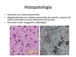 Histopatologia
• Astrocitos con núcleo pleomorfico
• Oligodendrocitos con núcleos aumentados de tamaño y aspecto de
  vidrio esmerilado y escasa inflamacón perivascular.
• Particulas virales “spaguethi y albondigas”
 