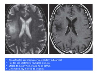 •   Zonas focales asimetricas periventricular y subcortical.
•   Pueden ser bilaterales, múltiples o únicas
•   Efecto de masa y hemorragia no es común
•   Gmente no hay mejoria de lesiones.
 
