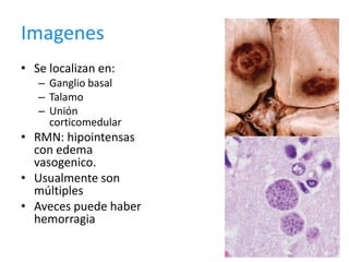 Imagenes
• Se localizan en:
   – Ganglio basal
   – Talamo
   – Unión
     corticomedular
• RMN: hipointensas
  con edema
  vasogenico.
• Usualmente son
  múltiples
• Aveces puede haber
  hemorragia
 