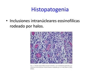 Histopatogenia
• Inclusiones intranúcleares eosinofilicas
  rodeado por halos.
 