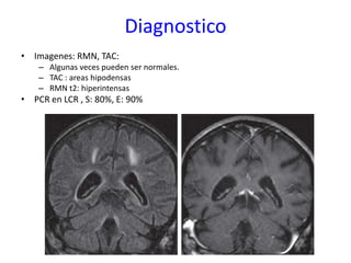 Diagnostico
• Imagenes: RMN, TAC:
    – Algunas veces pueden ser normales.
    – TAC : areas hipodensas
    – RMN t2: hiperintensas
• PCR en LCR , S: 80%, E: 90%
 