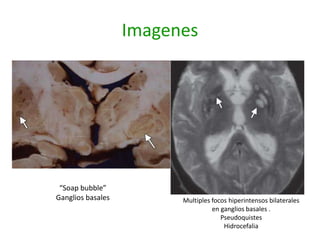 Imagenes




 “Soap bubble”
Ganglios basales         Multiples focos hiperintensos bilaterales
                                   en ganglios basales .
                                      Pseudoquistes
                                       Hidrocefalia
 