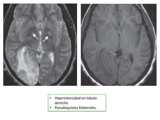 • Hiperintensidad en lobulo
  derecho
• Pseudoquistes bilaterales.
 