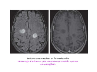 Lesiones que se realzan en forma de anillo
Hemorragia + lesiones + pcte inmunocomprometido = pensar
                      en aspergillosis
 