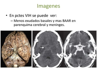 Imagenes
• En pctes VIH se puede ver:
  – Menos exudados basales y mas BAAR en
    parenquima cerebral y meninges.
 