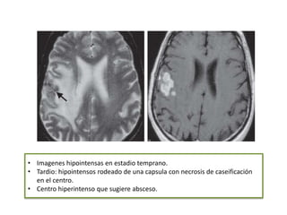 • Imagenes hipointensas en estadio temprano.
• Tardio: hipointensos rodeado de una capsula con necrosis de caseificación
  en el centro.
• Centro hiperintenso que sugiere absceso.
 