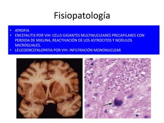 Fisiopatología
• ATROFIA
• ENCEFALITIS POR VIH: CELLS GIGANTES MULTINUCLEARES PRECAPILARES CON
  PERDIDA DE MIELINA, REACTIVACIÓN DE LOS ASTROCITOS Y NODULOS
  MICROGLIALES.
• LEUCOENCEFALOPATIA POR VIH: INFILTRACIÓN MONONUCLEAR
 