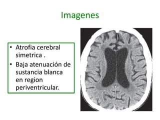 Imagenes


• Atrofia cerebral
  simetrica .
• Baja atenuación de
  sustancia blanca
  en region
  periventricular.
 