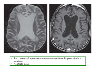 • Surco y venticulos prominentes que muestran la atrofia generalizada y
  simetrica.
• No efecto masa.
 