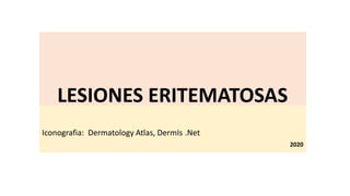 LESIONES ERITEMATOSAS
Iconografia: Dermatology Atlas, DermIs .Net
2020
 