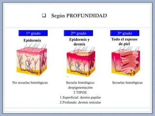  Según PROFUNDIDAD
No secuelas histológicas Secuela histológica:
despigmentación
2 TIPOS:
1.Superficial: dermis papilar
2.Profundo: dermis reticular
Secuelas histológicas
Epidermis Epidermis y
dermis
Todo el espesor
de piel
 