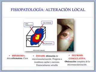 FISIOPATOLOGÍA: ALTERACIÓN LOCAL
 HIPEREMIA:
área eritematosa. Cura
 ÉSTASIS: dilatación de
microvascularización. Progresa a
trombosis capilar y necrosis.
Potencialmente salvable
 NECROSIS
COAGULATIVA:
Obstrucción completa de la
microvascularización.
 
