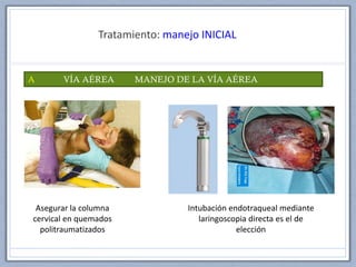 Tratamiento: manejo INICIAL
A VÍA AÉREA MANEJO DE LA VÍA AÉREA
Asegurar la columna
cervical en quemados
politraumatizados
Intubación endotraqueal mediante
laringoscopia directa es el de
elección
 