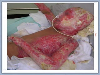 Tratamiento: manejo INICIAL
C CIRCULACIÓN
Accesos intravenosos  INMEDIATO
• 2 vías venosas periféricas gruesas (16G o 14G )
• Preferible en EESS, evitar EEII por riesgo TVP
• No está contraindicado acceso venoso en área quemada  riesgo
de émbolo séptico
• Si SCQ > 25% (quemadura grave) canalizar vía venosa central
 