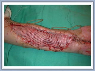 Tratamiento HOSPITALARIO: Tratamiento quirúrgico
o INDICACIÓN  Quemaduras de 2º grado profundas y 3º, 4º
o 2 TIPOS DE TRATAMIENTO
• Escarectomía o incisión URGENCIA
Debe realizarse precozmente, en las primeras 48 h
Incisiones que se realizan en quemaduras circunferenciales
Objetivo: evitar el SÍNDROME COMPARTIMENTAL
• Escisión y cobertura
Eliminación de la escara y cobertua de la zona con autoinjertos
Si es muy extensa la quemadura : coberturas artificiales
 