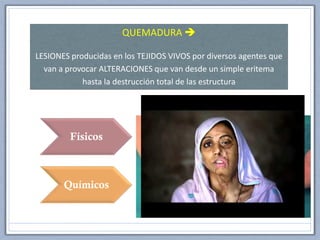 Físicos
Químicos
• Radiaciones suelen ser superficiales
• Térmicas agua caliente 44,5%
• Electricidad muy profundas
• Ácidos
• Álcalis
• Otros: agentes oxidantes, corrosivos,
etc
QUEMADURA 
LESIONES producidas en los TEJIDOS VIVOS por diversos agentes que
van a provocar ALTERACIONES que van desde un simple eritema
hasta la destrucción total de las estructura
 