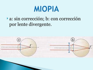 a: sin corrección; b: con corrección por lente divergente. 