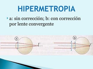 a: sin corrección; b: con corrección por lente convergente 
