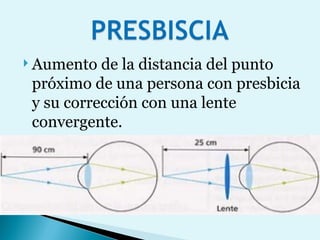 Aumento de la distancia del punto próximo de una persona con presbicia y su corrección con una lente convergente. 