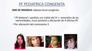 PF PEDIATRICA CONGENITA
SME DE MOEBIUS: diplejia facial congénita
PF bilateral + parálisis uni o bilat del VI +- anomalías de las
extremidades, musc pectoral y afectación de 4 últimos PC
Por alteración del cromosoma 3
 