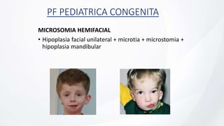 PF PEDIATRICA CONGENITA
MICROSOMIA HEMIFACIAL
• Hipoplasia facial unilateral + microtia + microstomia +
hipoplasia mandibular
 