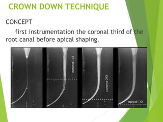 CROWN DOWN TECHNIQUE
CONCEPT
first instrumentation the coronal third of the
root canal before apical shaping.
 