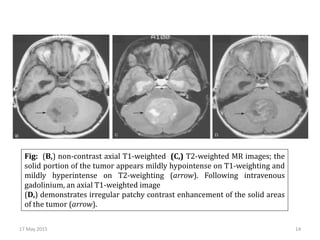 Fig: (B,) non-contrast axial T1-weighted (C,) T2-weighted MR images; the
solid portion of the tumor appears mildly hypointense on T1-weighting and
mildly hyperintense on T2-weighting (arrow). Following intravenous
gadolinium, an axial T1-weighted image
(D,) demonstrates irregular patchy contrast enhancement of the solid areas
of the tumor (arrow).
17 May 2015 14
 