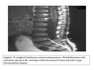 Sagittal , T1 weighted Gadolinium contrast enhancement – Medulloblastoma with
metastatic spread to the meninges within the posterior fossa and with a large
intramedullary deposit.
 