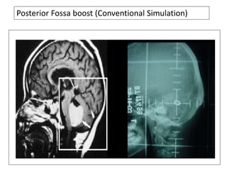 Posterior Fossa boost (Conventional Simulation)
 