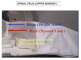 SPINAL FIELD (UPPER BORDER )
 