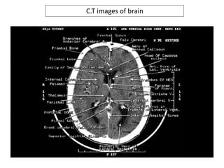 C.T images of brain
 