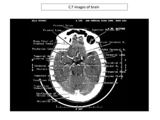 C.T images of brain
 