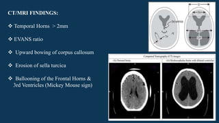 CT/MRI FINDINGS:
 Temporal Horns > 2mm
 EVANS ratio
 Upward bowing of corpus callosum
 Erosion of sella turcica
 Ballooning of the Frontal Horns &
3rd Ventricles (Mickey Mouse sign)
 