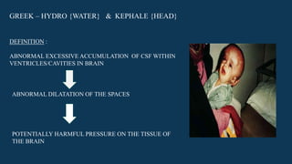 GREEK – HYDRO {WATER} & KEPHALE {HEAD}
DEFINITION :
ABNORMAL EXCESSIVE ACCUMULATION OF CSF WITHIN
VENTRICLES/CAVITIES IN BRAIN
ABNORMAL DILATATION OF THE SPACES
POTENTIALLY HARMFUL PRESSURE ON THE TISSUE OF
THE BRAIN
 
