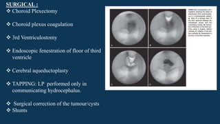 SURGICAL :
 Choroid Plexectomy
 Choroid plexus coagulation
 3rd Ventriculostomy
 Endoscopic fenestration of floor of third
ventricle
 Cerebral aqueductoplasty
 TAPPING: LP performed only in
communicating hydrocephalus.
 Surgical correction of the tumour/cysts
 Shunts
 
