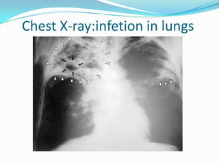 Chest X-ray:infetion in lungs
 