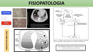 FISIOPATOLOGIA
CONCEPTO
DE
BABY
LUNG
 